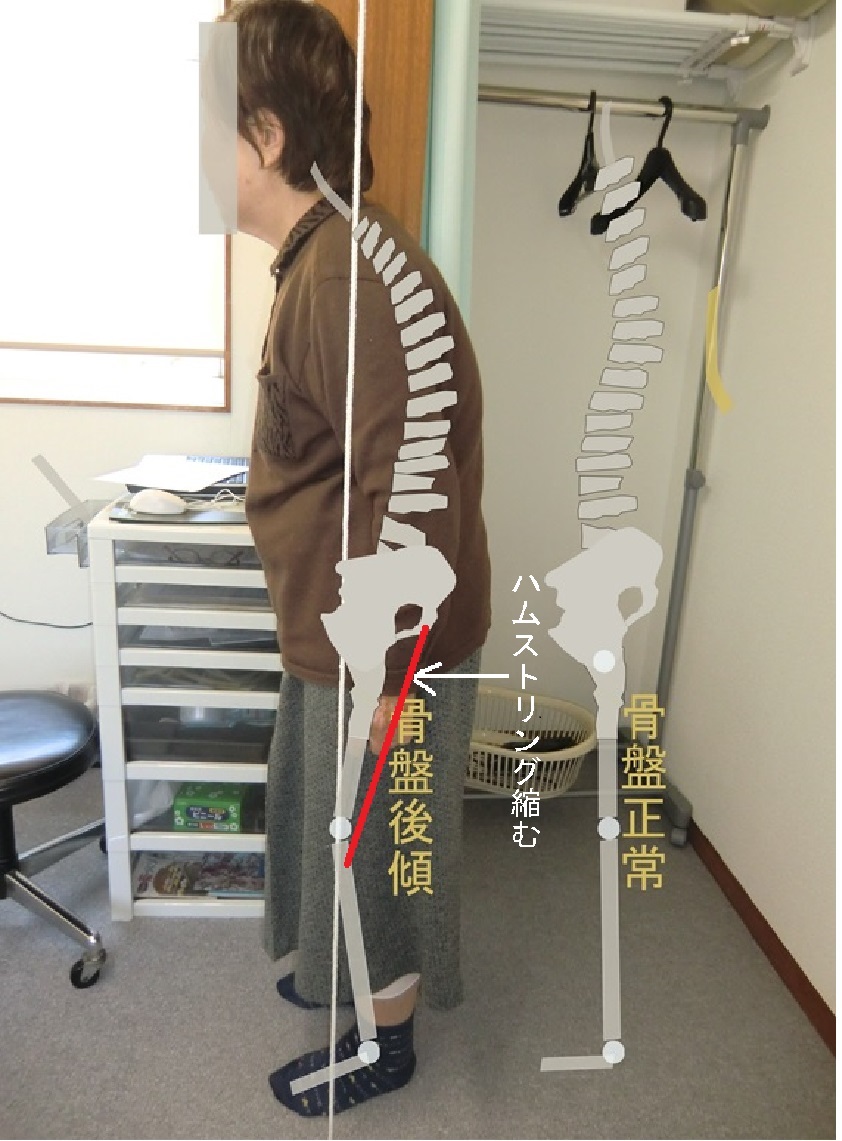 腰痛は骨盤の改善から