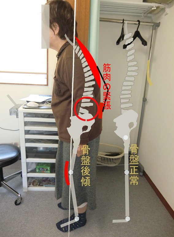 腰痛は骨盤の改善から