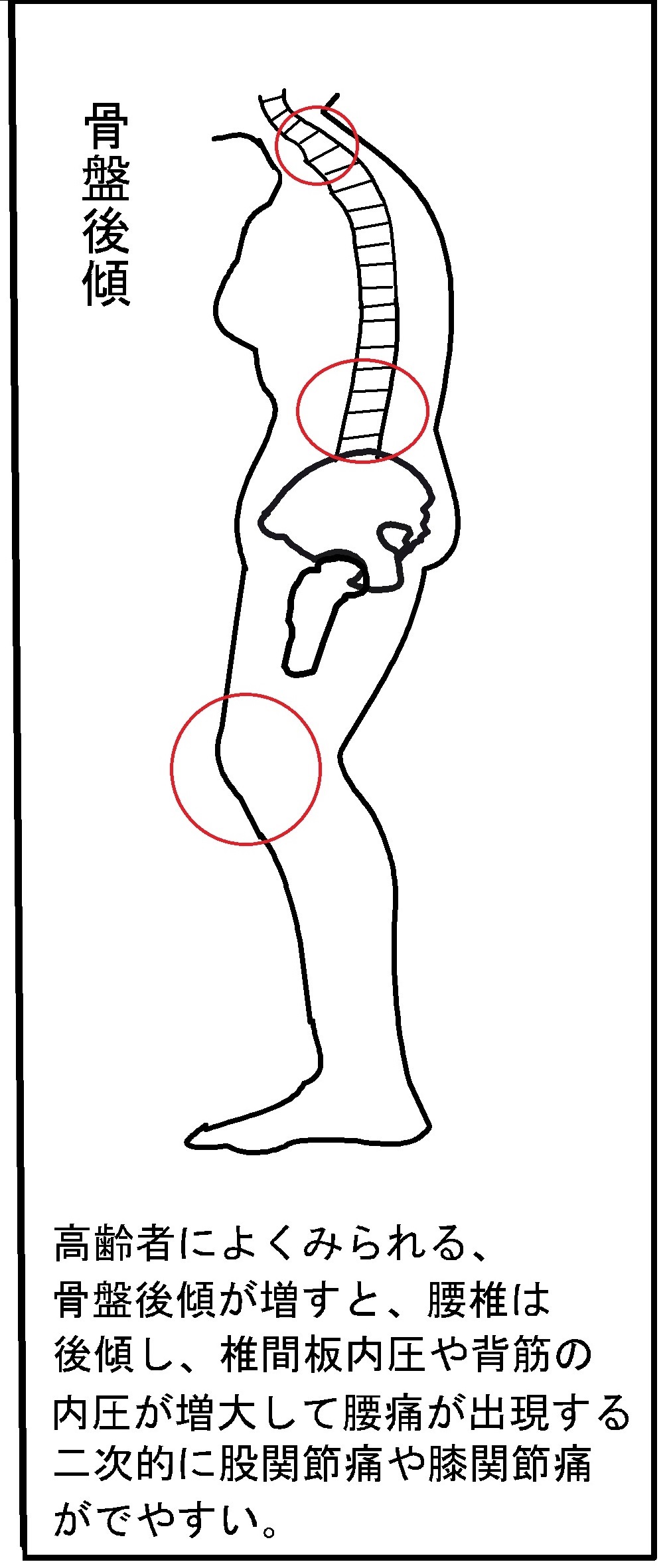 腰痛は骨盤の改善から